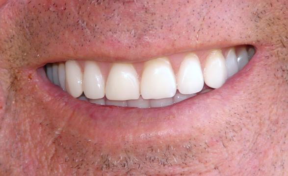 Совершенно новые зубы. Фото Свободно для коммерческого использования, Атрибуция не требуется. Бесплатное стоковое фото для свободного скачивания
