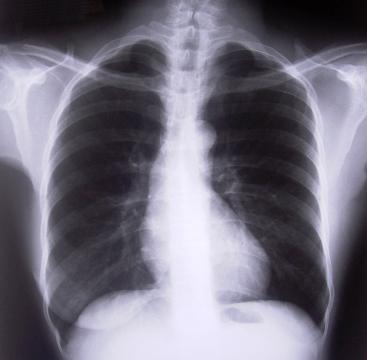 Рентген грудной клетки. Фото Свободно для коммерческого использования, Атрибуция не требуется. Бесплатное стоковое фото для свободного скачивания