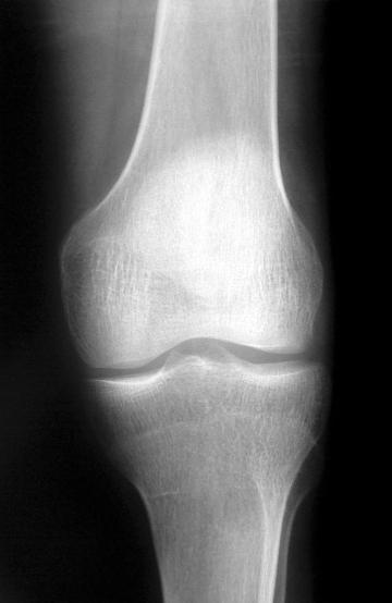 Рентген колена. Фото Free for commercial use, No attribution required. Бесплатное стоковое фото для свободного скачивания