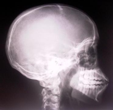 Рентгеновский снимок черепа. Фото Free for commercial use, No attribution required. Бесплатное стоковое фото для свободного скачивания